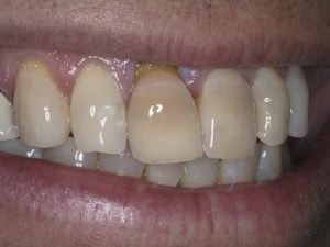 Smile discolorations