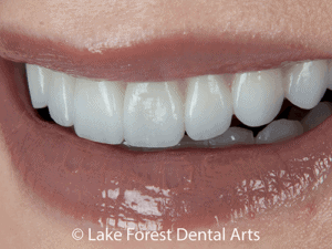Will veneers ruin my teeth