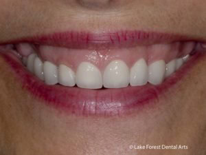 Crown lengthening for a gummy smile