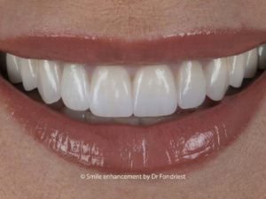 Not all Cosmetic dentistry is the same. Full mouth reconstruction