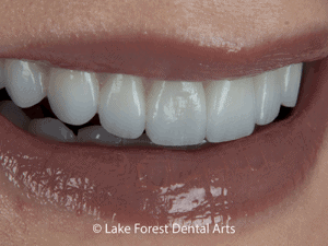 dental veneers