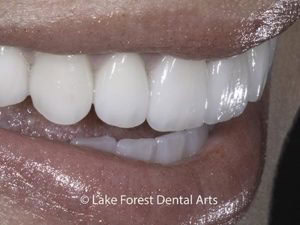 Whiter Smile