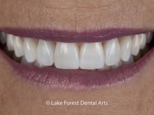 Are veneers worth it?