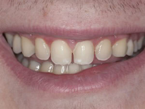 Gapped Teeth