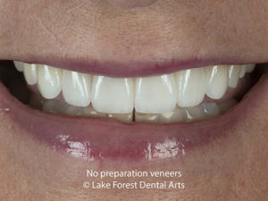 No-preparation veneers