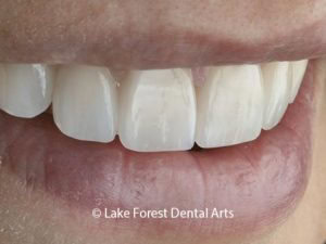 Dental crowns