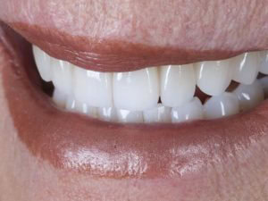 enhancing your smile