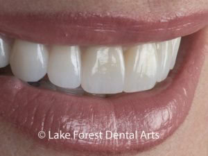 Front tooth enhancements