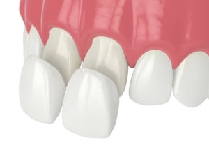 placing veneers