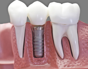 Single Tooth Replacement