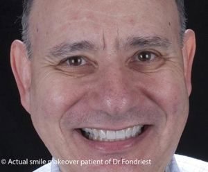 hi-quality porcelain fused to metal crowns