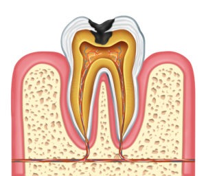 cavity repair gel in development