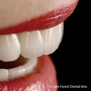 Dental bridge to close gap between teeth Close gaps between teeth