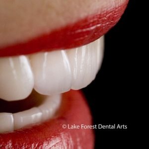 porcelain crowns