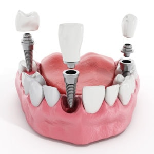 dental model showing implants and crowns