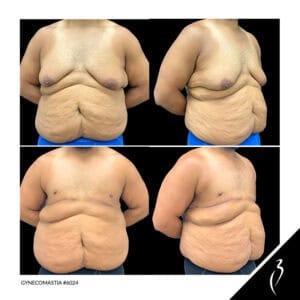Patient Age: 34-year-old, Male Patient Issue: He wanted to get rid of excessive skin around the breast area.
