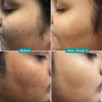 Pilgrim 10% Vitamin C Face Serum For Daily Brightness 30 ml | Face serum for glowing skin | Reduces Dark Spots & Evens Skin Tone | Fragrance Free | For Men and Women | All Skin Types | - Image 8