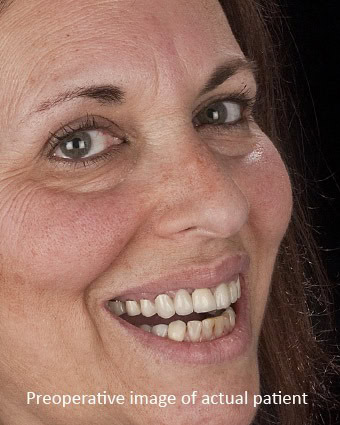 Black lines at gum line, crowns with dark margins Before: This Highland Park patient wanted a brighter healthier smile. She hated the black lines on her crowns at the gumline and the varied unnatural look to the existing crown work. Her floss would shred on her poorly fitting dentistry.
