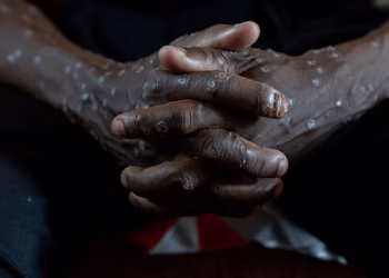 A man suffering from monkeypox waits for treatment at Kamituga General Hospital in South Kivu (Congo), on September 4, 2024.   - 
Copyright © africanews
AP Photo/Moses Sawasawa