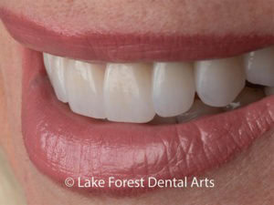 Smile makeover done by Dr. Fondriest Getting a better smile