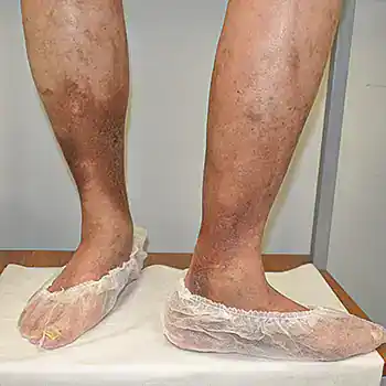 Тромбоз глубоких вен