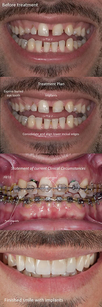 Dental implant benefits