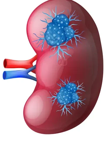 Penyebab Gagal Ginjal yang Harus Diwaspadai Sejak Usia Muda