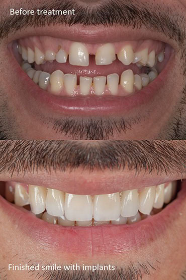 Smile makeover before and after Prosthodontic dental treatment for a better smile makeover