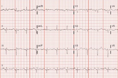 A 57-Year-Old Female with Cardiological History and Shortness of Breath A 57-Year-Old Female with Cardiological History and Shortness of Breath