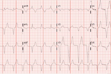 A 36-Year-Old Male with Sudden-Onset Substernal Chest Pain A 36-Year-Old Male with Sudden-Onset Substernal Chest Pain