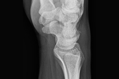 A 41-Year-Old with Dorsal Wrist Pain After a Slip-and-Fall A 41-Year-Old with Dorsal Wrist Pain After a Slip-and-Fall