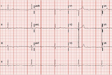 A 79-Year-Old Male with Left Shoulder Pain and a History of Hypertension and CAD A 79-Year-Old Male with Left Shoulder Pain and a History of Hypertension and CAD