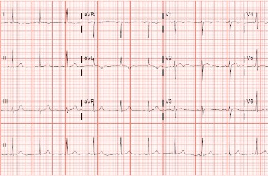A 61-Year-Old Woman with a 2-Day History of Chest Pain A 61-Year-Old Woman with a 2-Day History of Chest Pain