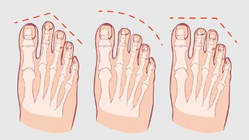 Ar žinote savo pėdos tipą?