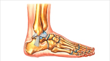 Čiurnos kryptelėjimas, patempti raiščiai?