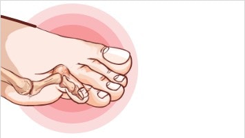 Sulinkę kojų pirštai. Kaip sau padėti?