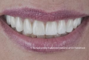 Smile makeover - after image Smile makeover - after image