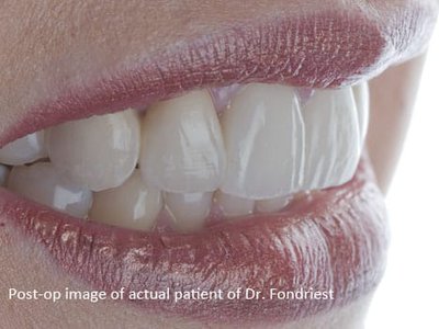 Dental Bridgework PFM dental bridgework