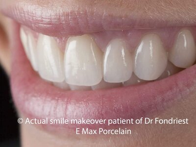 A "dental bridge" to replace a missing tooth Picture of dental bridge