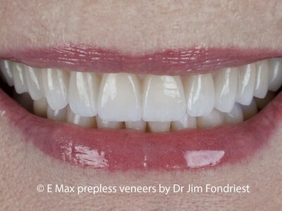 Low preparation tooth veneers Tooth Veneers without drilling