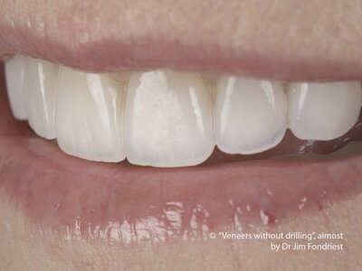 Prepless Tooth Veneers to change shape of teeth Tooth Veneers without drilling