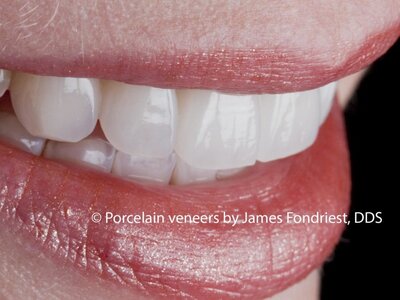Porcelain Veneers made of Feldspathic porcelain Porcelain Veneers
