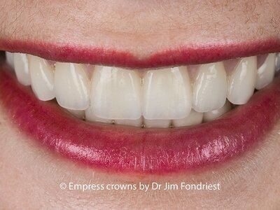 All porcelain restorations Empress is a type of porcelain crown