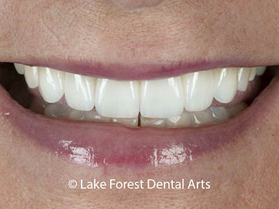 closeup photo of dental veneers dental veneers