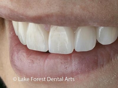 Veneers last a long time