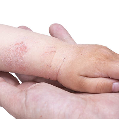 young child presenting with eczema seeking natural eczema relief