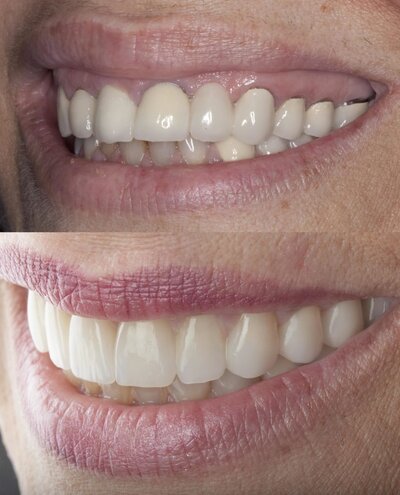 Getting rid of the black ring around base of crown Getting rid of the dark line at the edges of your crowns