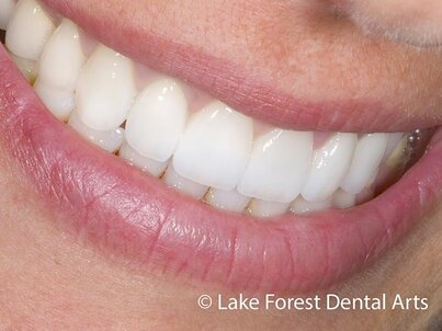 Smile makeover done with porcelain tooth covers Porcelain covers