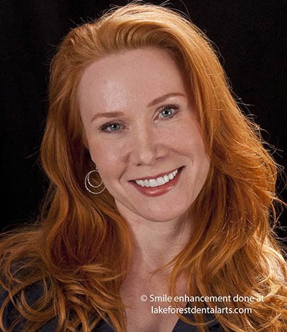 Smile makeover with veneers Artistic Dentistry done by an artistic dentist