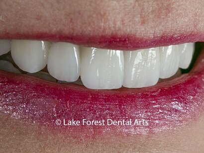 Porcelain veneers to replace old composite Are veneers better than crowns?